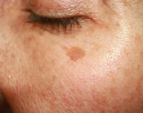 Brown and Red Spot Reduction Specialist
