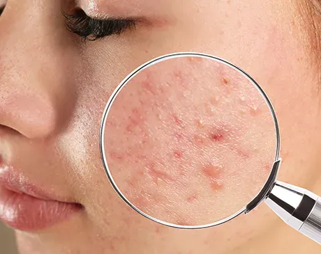 Acne Treatment Specialist