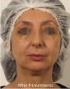 Facials